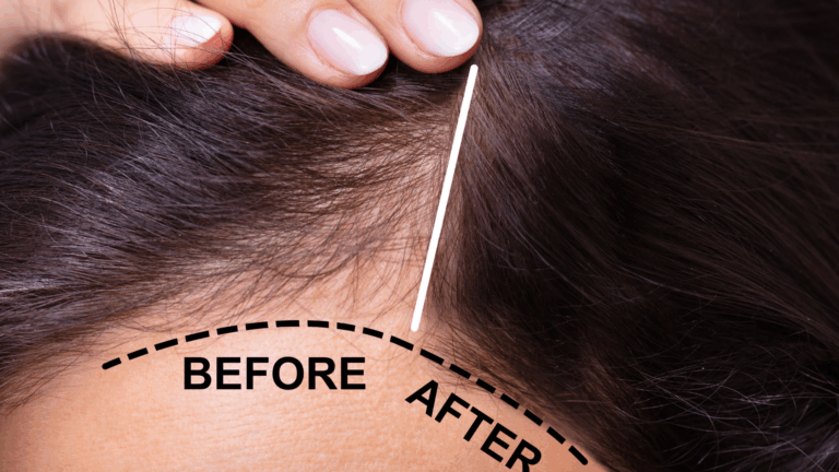 Hair Loss Treatment in Islamabad: From PRP to Medication – A Dermatologist’s Guide