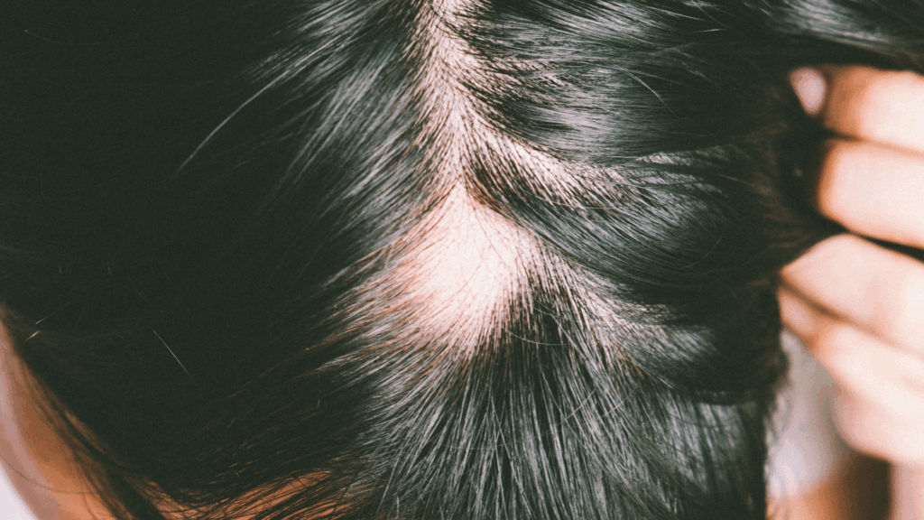Close-up image showing female pattern hair loss or alopecia on the scalp, highlighting the need for effective Hair Regrowth Treatment in Islamabad.