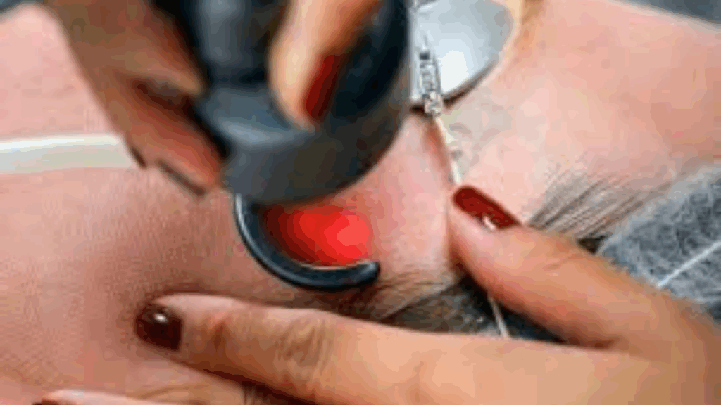 After PRP Treatment results in Islamabad